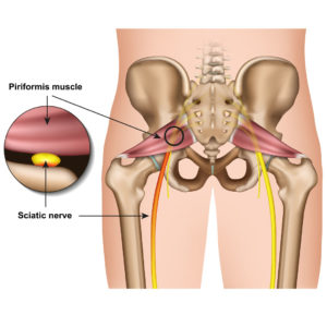 https://feel-electric.com/wp-content/uploads/2022/04/physiotherapy-sciatica-nerve-back-pain-ems-pain-relief-300x300.jpg